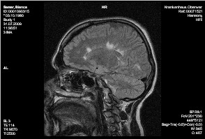 MRT-Bild Schädel bei MS