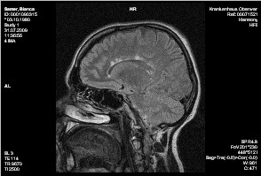 MRT-Bild Schädel bei MS