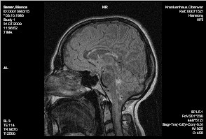 MRT-Bild Schädel bei MS
