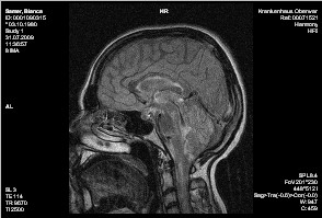 MRT-Bild Schädel bei MS