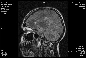 MRT-Bild Schädel bei MS