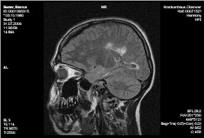 MRT-Bild Schädel bei MS