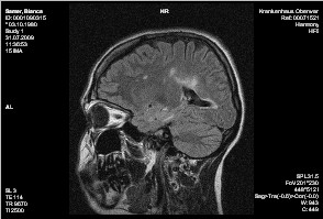 MRT-Bild Schädel bei MS
