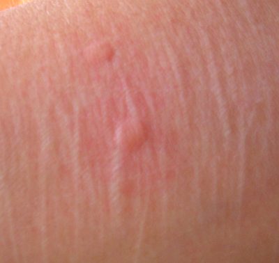 Tysabriausschlag -Quaddeln